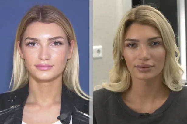 Giuliana Farfalla vorher nachher